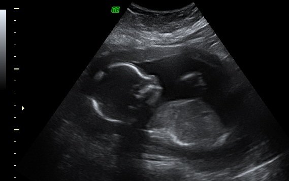 Sixth pregnancy journey-2